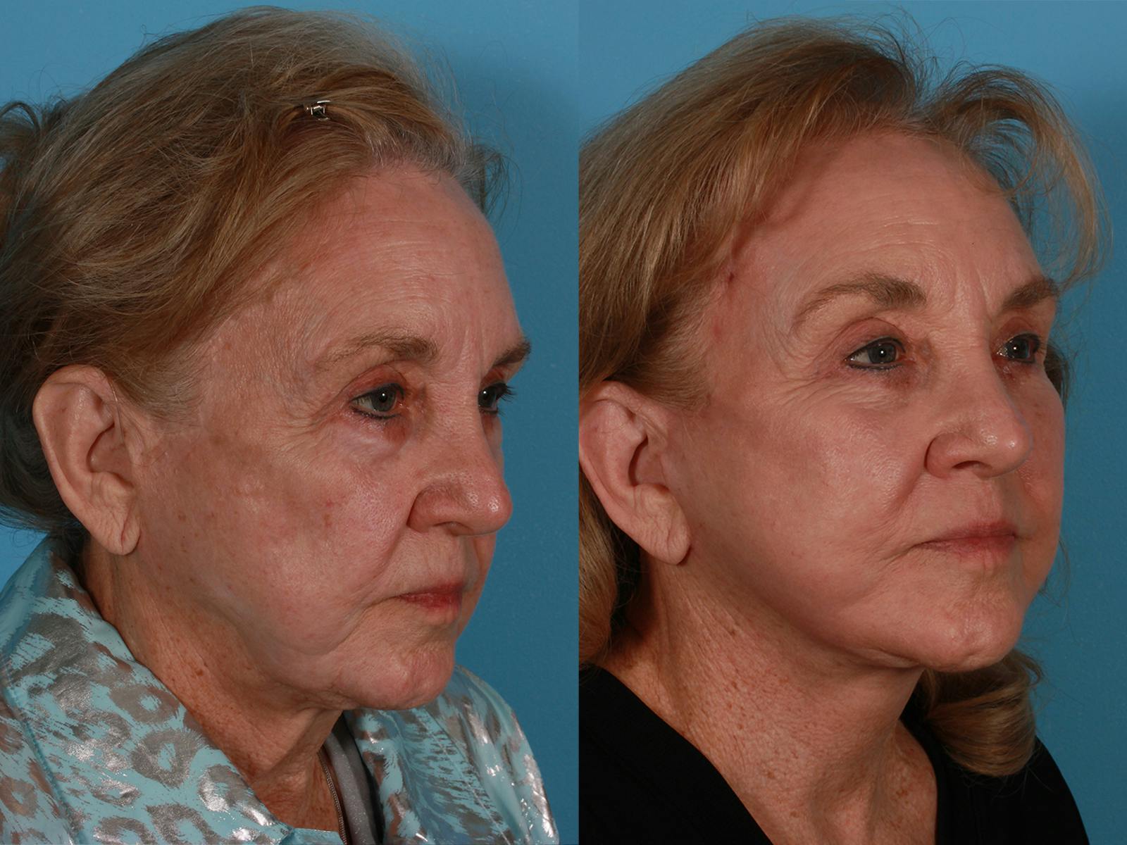 Endoscopic Brow Lift Before & After Gallery - Patient 220182 - Image 2
