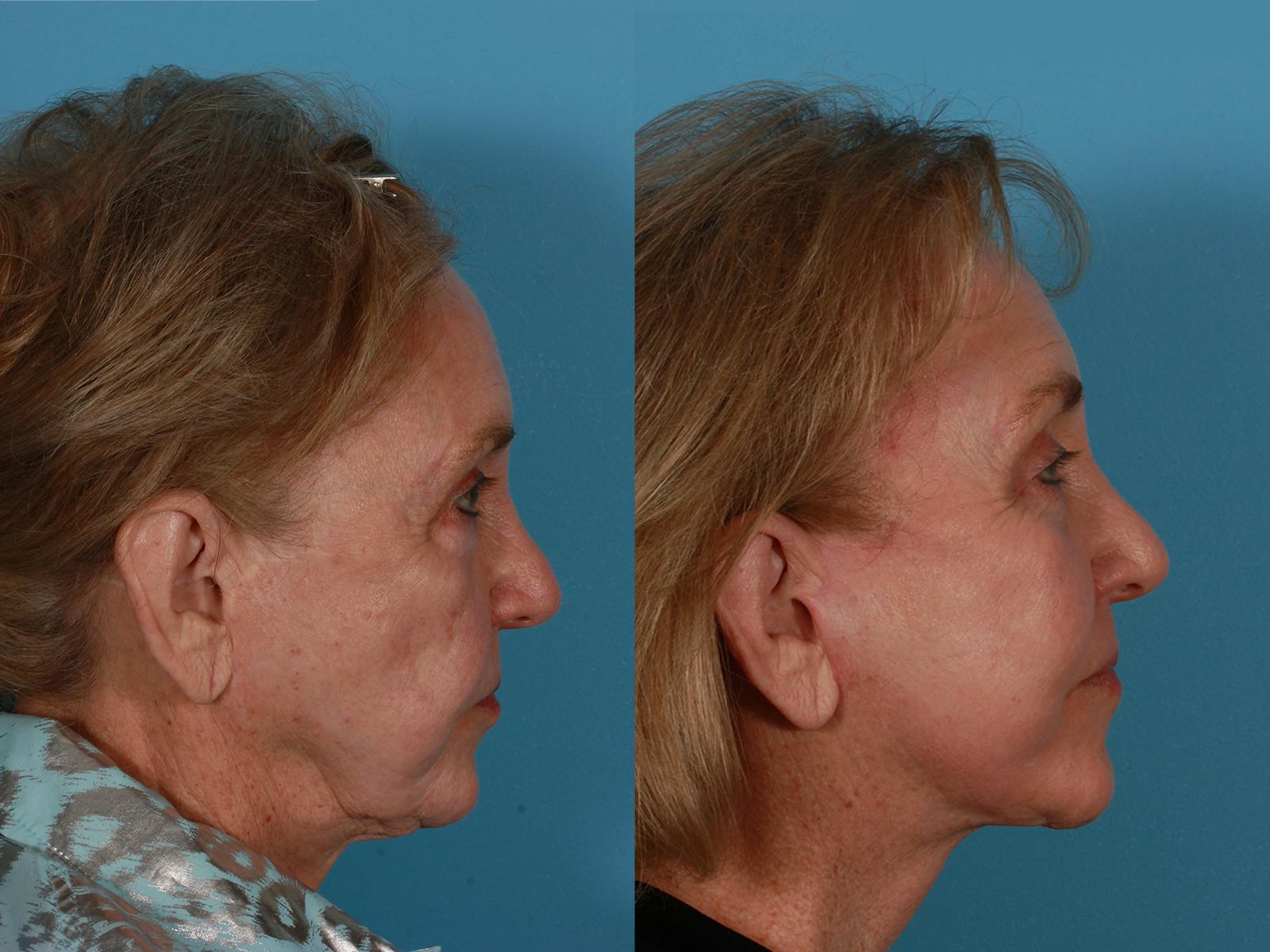Endoscopic Brow Lift Before & After Gallery - Patient 220182 - Image 3