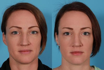 Nasal Obstruction Before & After Gallery - Patient 132748 - Image 1