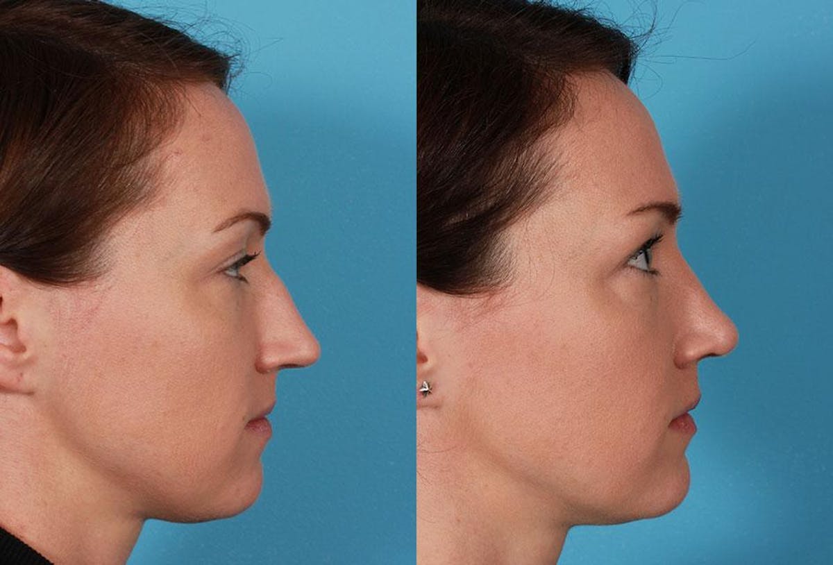 Nasal Obstruction Before & After Gallery - Patient 132748 - Image 2