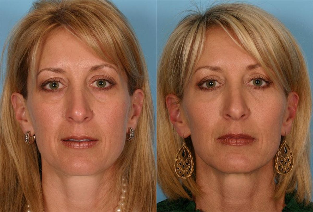 Facial Fat Transfer Before & After Gallery - Patient 336401 - Image 1