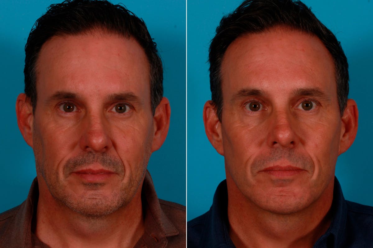 Limited Incision Facelift Before & After Gallery - Patient 621224 - Image 1