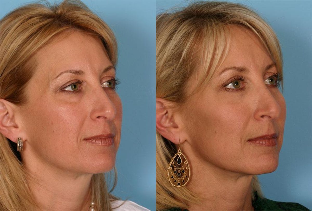 Facial Fat Transfer Before & After Gallery - Patient 336401 - Image 2