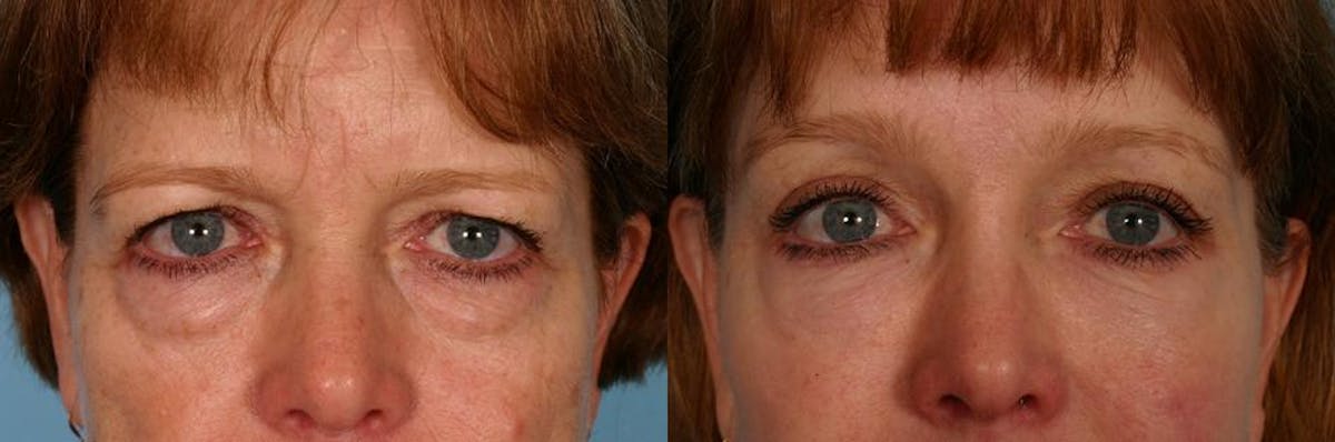 TCA Peel / Dermabrasion Before & After Gallery - Patient 366275 - Image 4