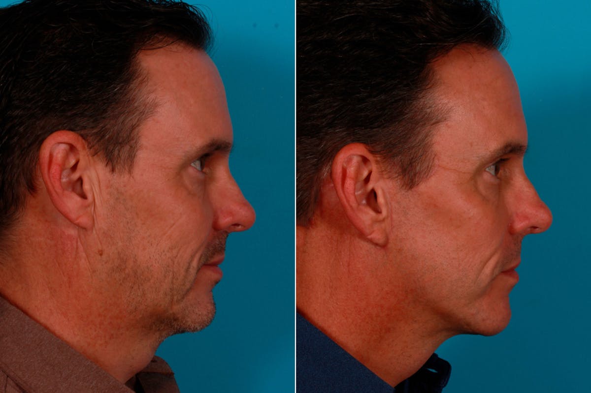 Limited Incision Facelift Before & After Gallery - Patient 621224 - Image 2