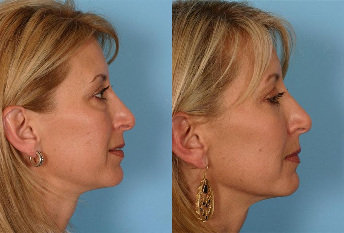 Facial Fat Transfer Before & After Gallery - Patient 336401 - Image 3