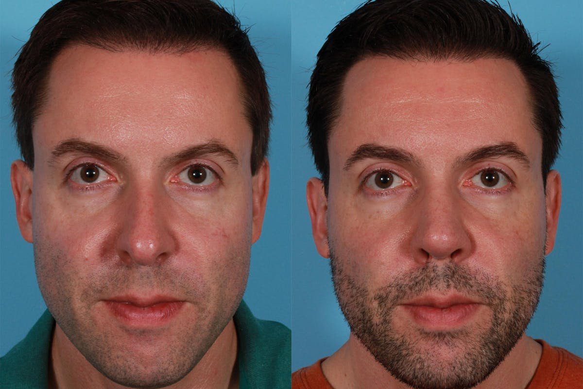 Nasal Obstruction Before & After Gallery - Patient 309474 - Image 1