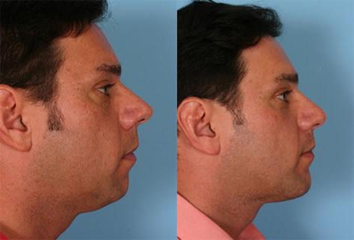 Rhinoplasty Before & After Gallery - Patient 185242 - Image 2