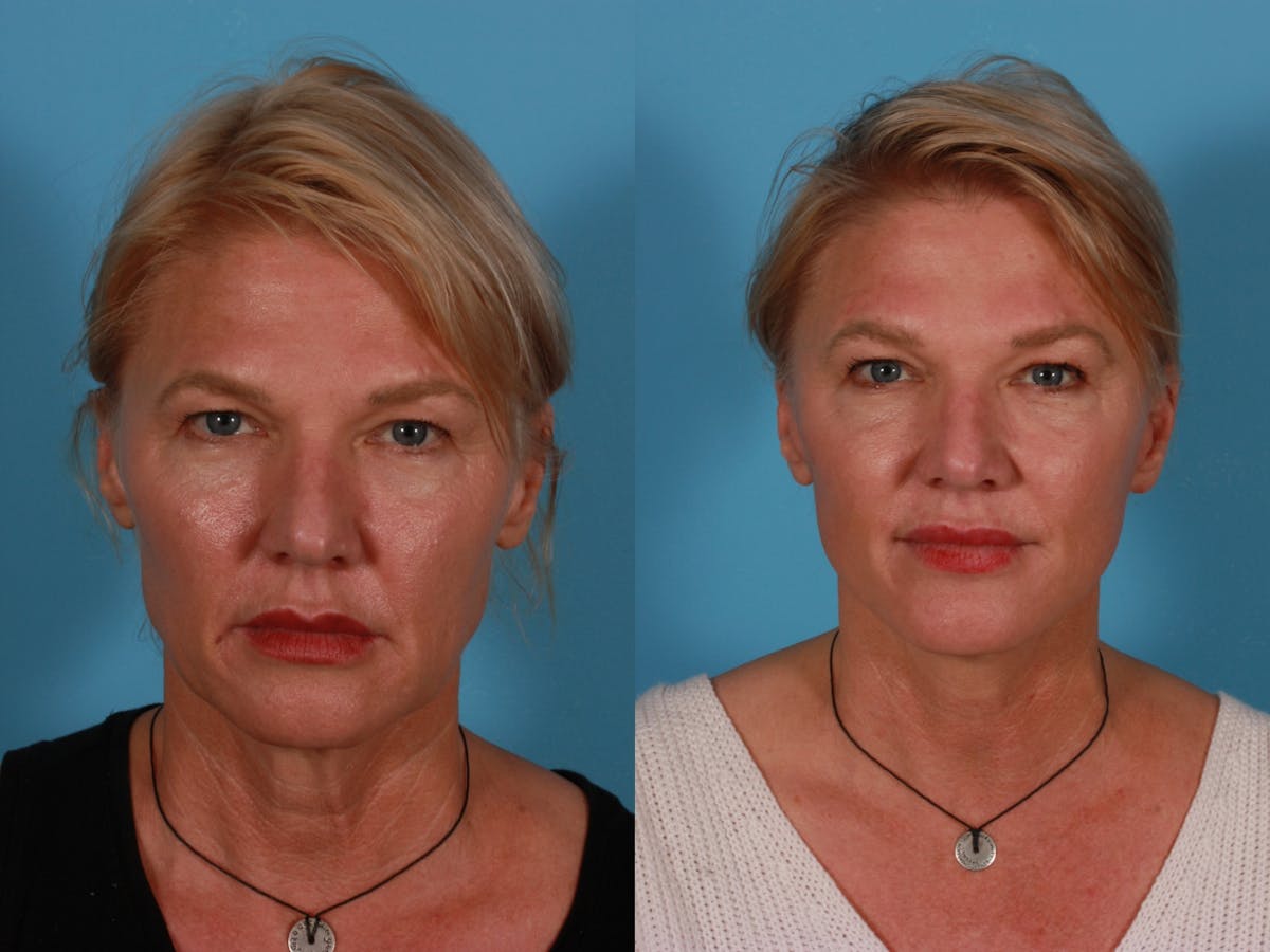 Endoscoplic Browlift Before & After Gallery - Patient 268959 - Image 1