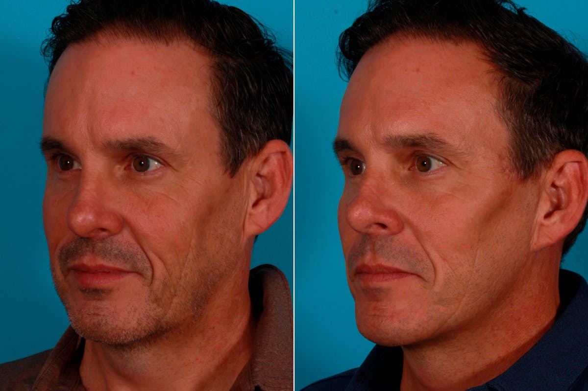 Limited Incision Facelift Before & After Gallery - Patient 621224 - Image 3