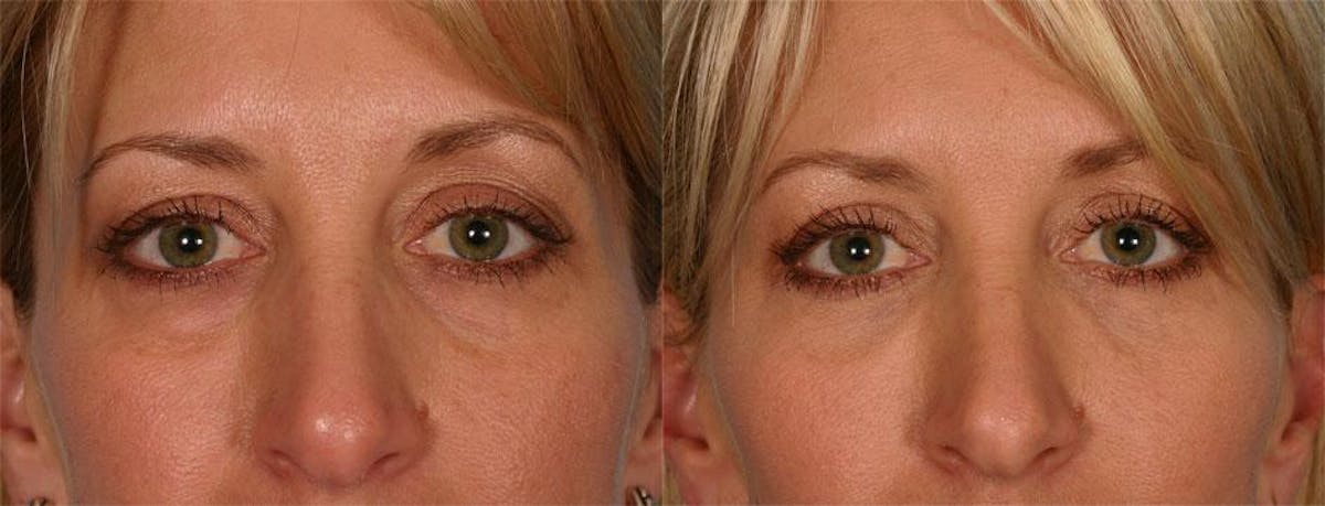 Facial Fat Transfer Before & After Gallery - Patient 336401 - Image 4