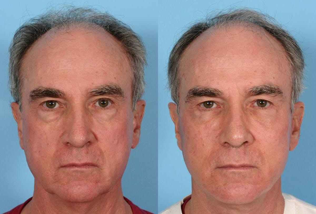 Facelift Before & After Gallery - Patient 353293 - Image 1
