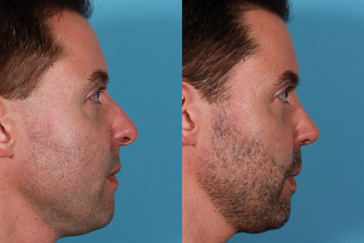 Nasal Obstruction Before & After Gallery - Patient 309474 - Image 2