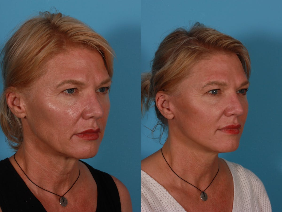 Endoscoplic Browlift Before & After Gallery - Patient 268959 - Image 2