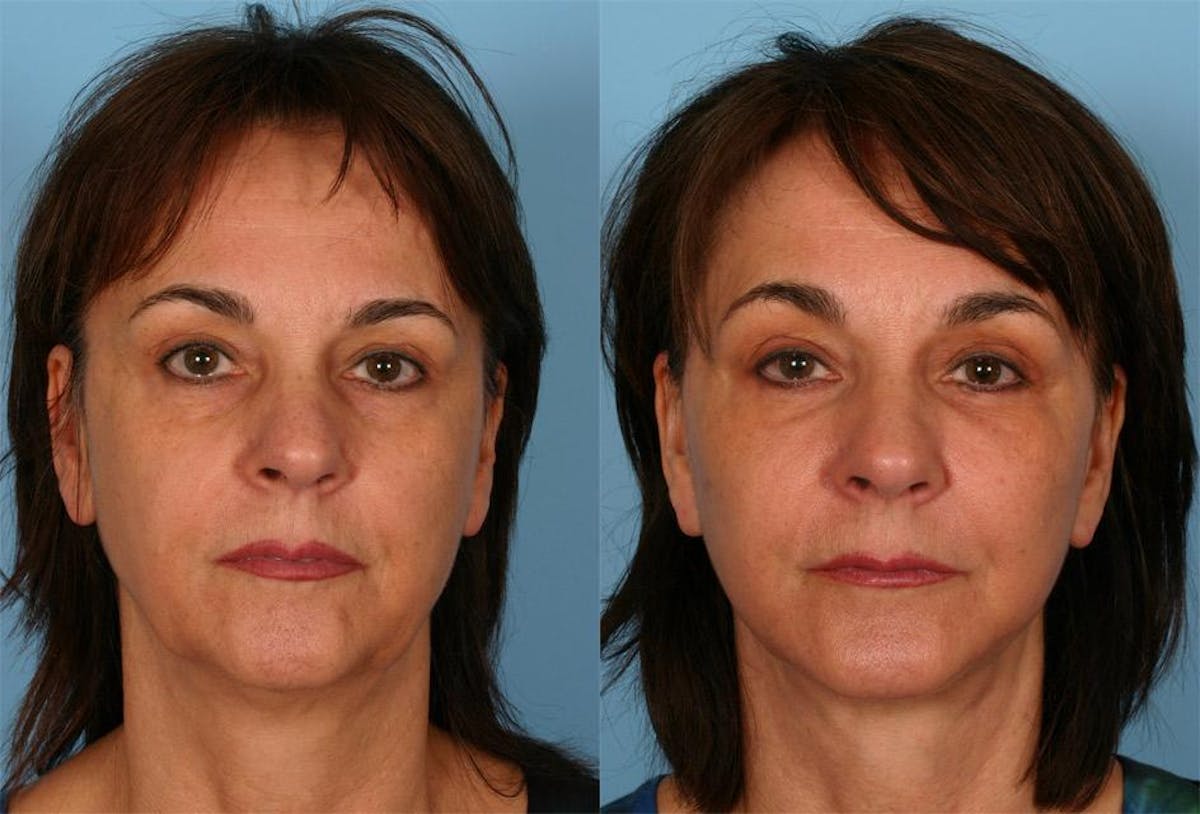 Facial Fat Transfer Before & After Gallery - Patient 346632 - Image 1