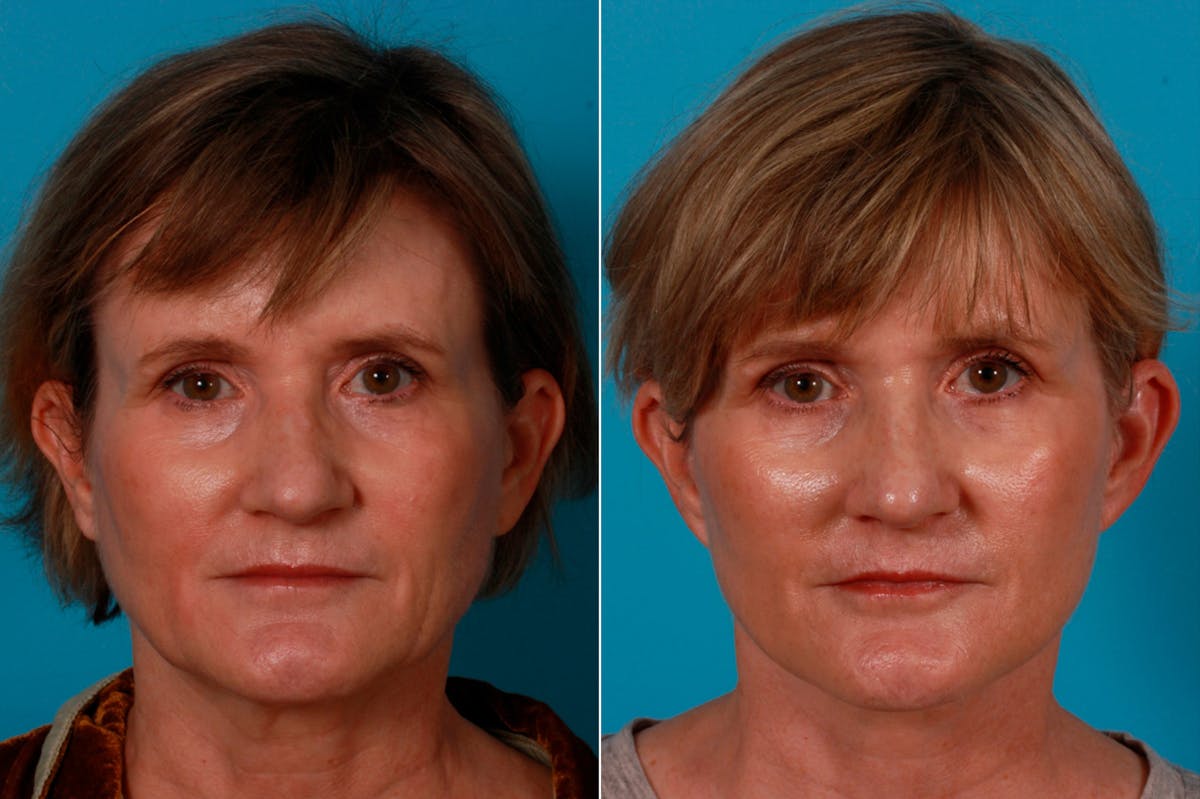 Limited Incision Facelift Before & After Gallery - Patient 200700 - Image 1