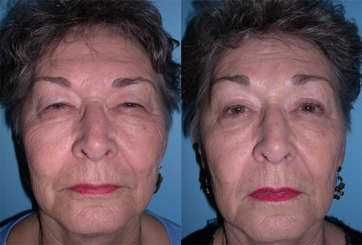 Eyelid Surgery (Blepharoplasty) Before & After Gallery - Patient 193922 - Image 1