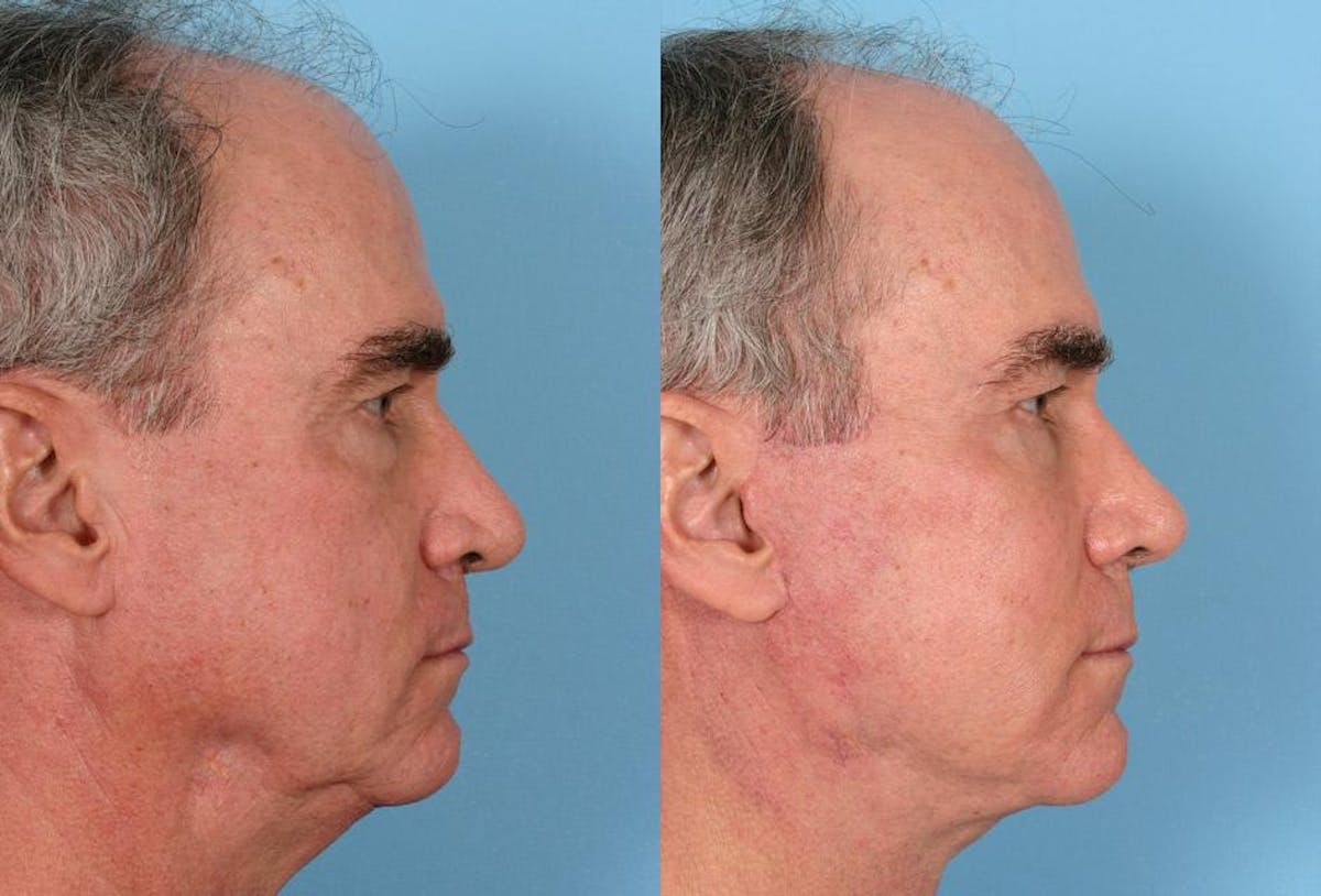 Facelift Before & After Gallery - Patient 353293 - Image 3