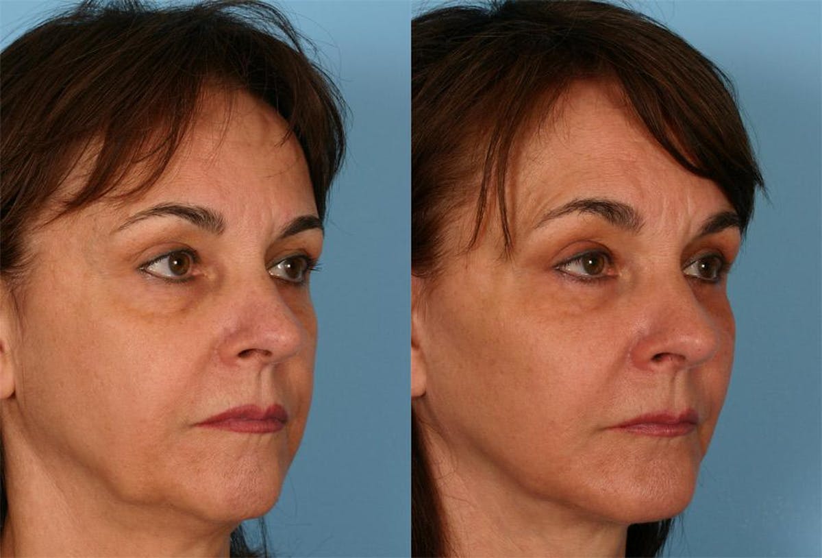 Facial Fat Transfer Before & After Gallery - Patient 346632 - Image 2