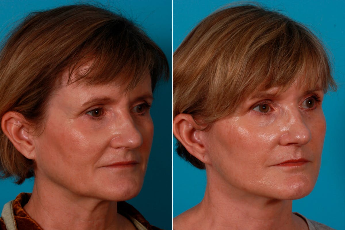 Limited Incision Facelift Before & After Gallery - Patient 200700 - Image 2