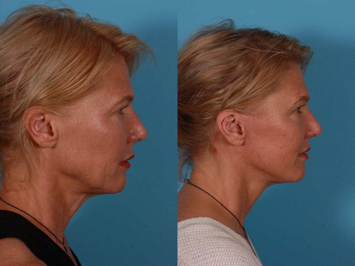 Endoscoplic Browlift Before & After Gallery - Patient 268959 - Image 3