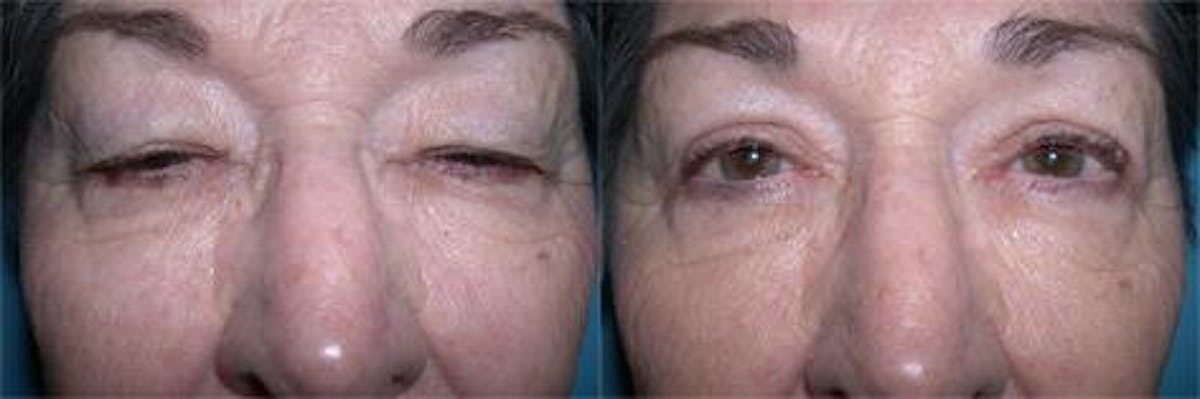 Eyelid Surgery (Blepharoplasty) Before & After Gallery - Patient 193922 - Image 2