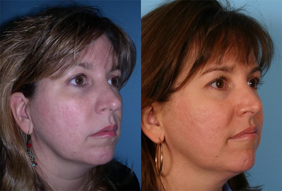 Acne Scarring Before & After Gallery - Patient 242281 - Image 2