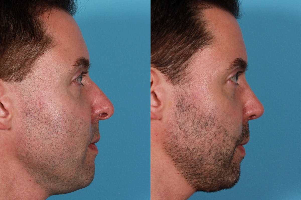 Nasal Obstruction Before & After Gallery - Patient 309474 - Image 4