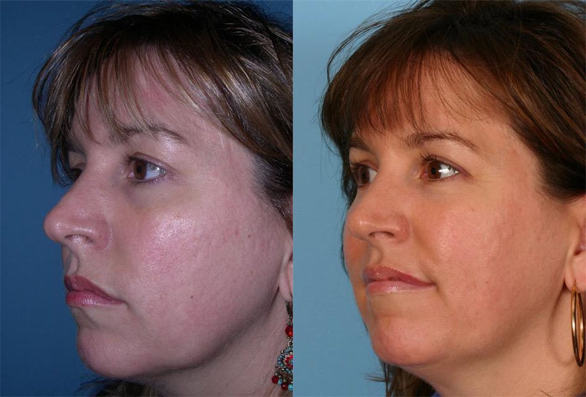 Acne Scarring Before & After Gallery - Patient 242281 - Image 3