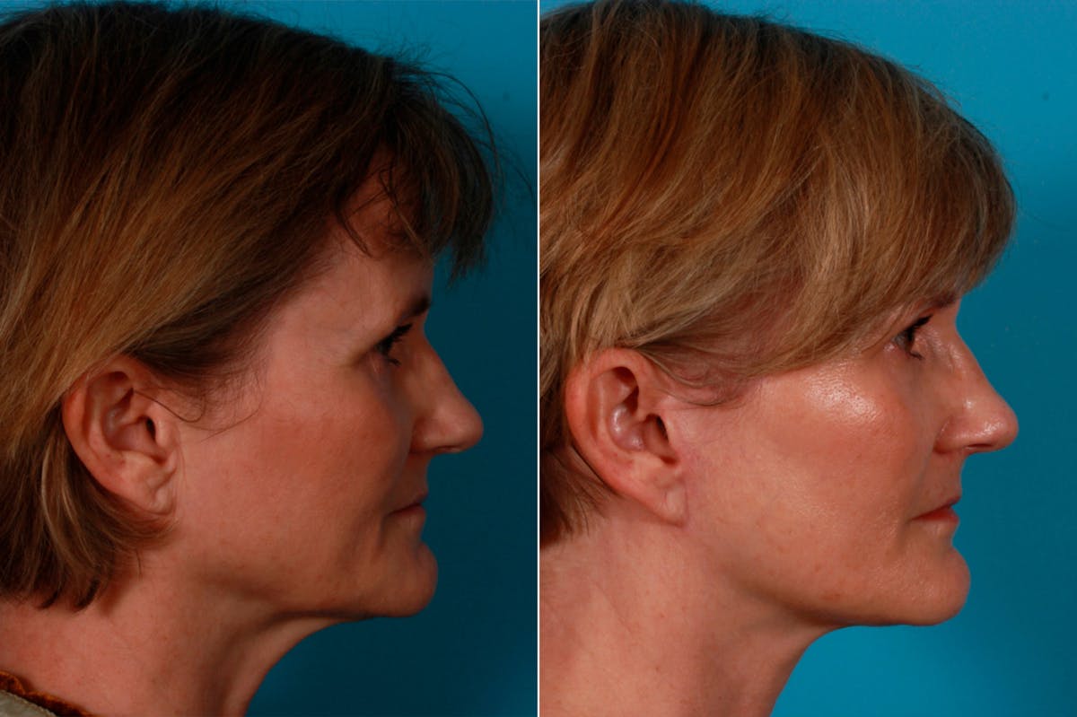 Limited Incision Facelift Before & After Gallery - Patient 200700 - Image 3