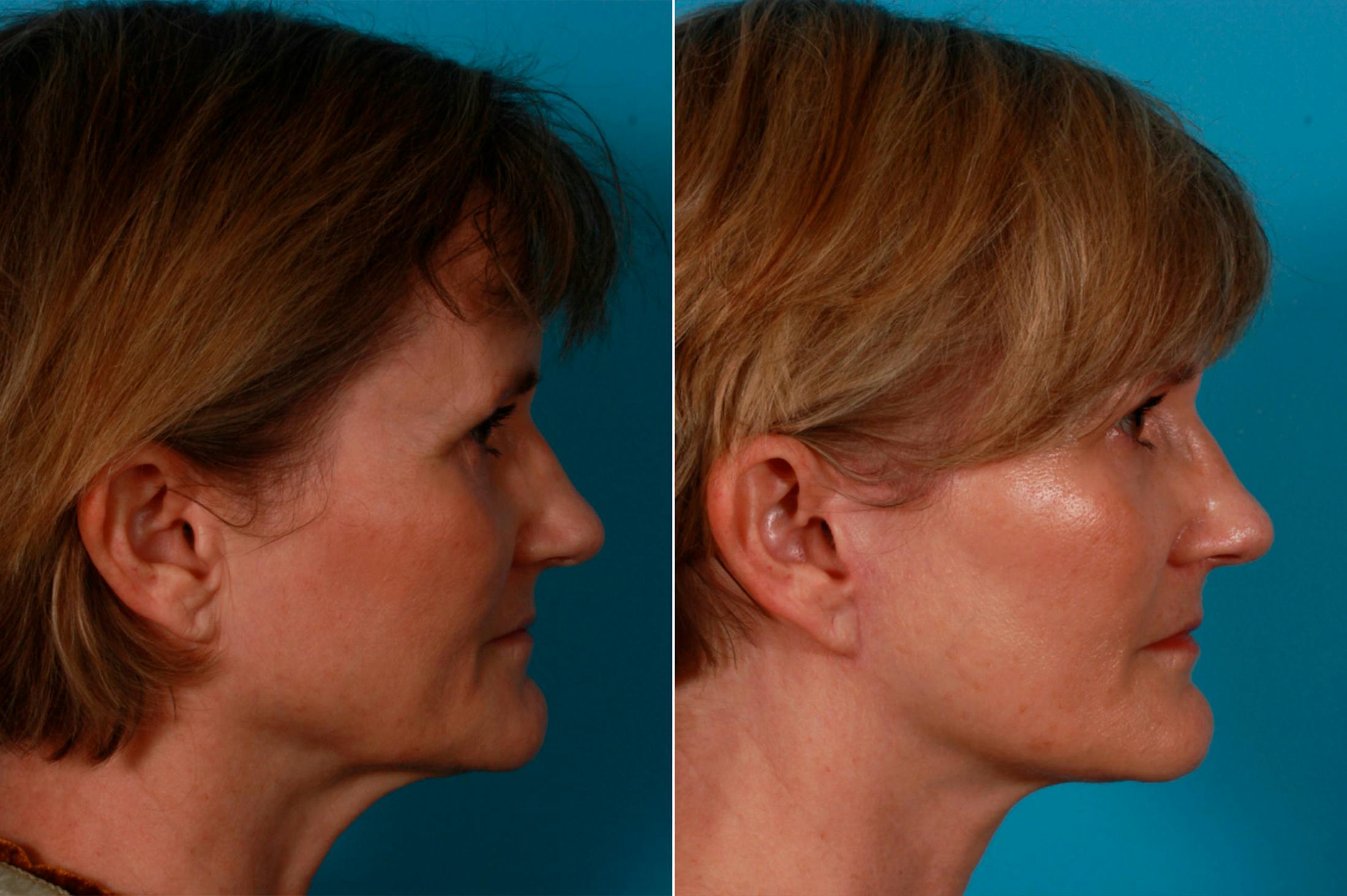Limited Incision Facelift Before & After Gallery - Patient 200700 - Image 3