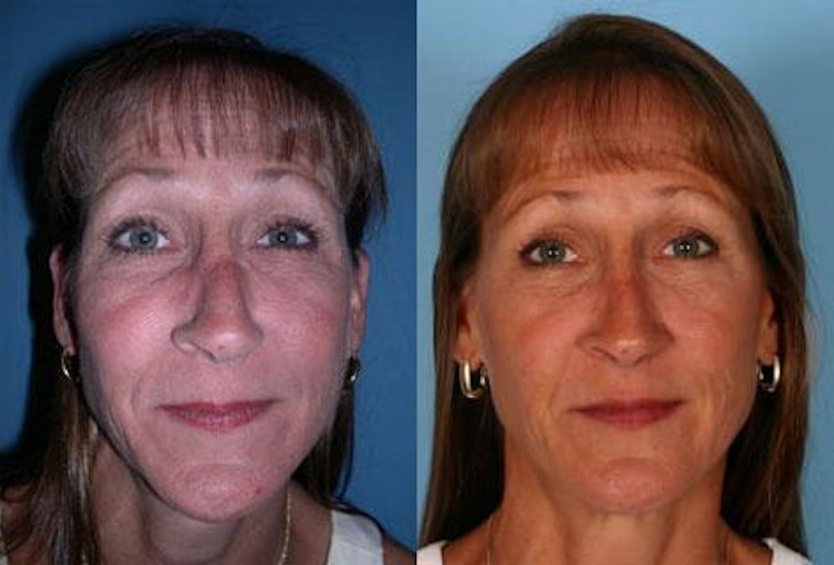 Rhinoplasty Before & After Gallery - Patient 380543 - Image 1