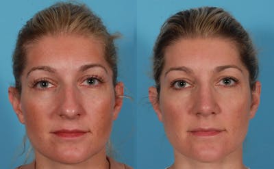 Nasal Obstruction Before & After Gallery - Patient 757894 - Image 1