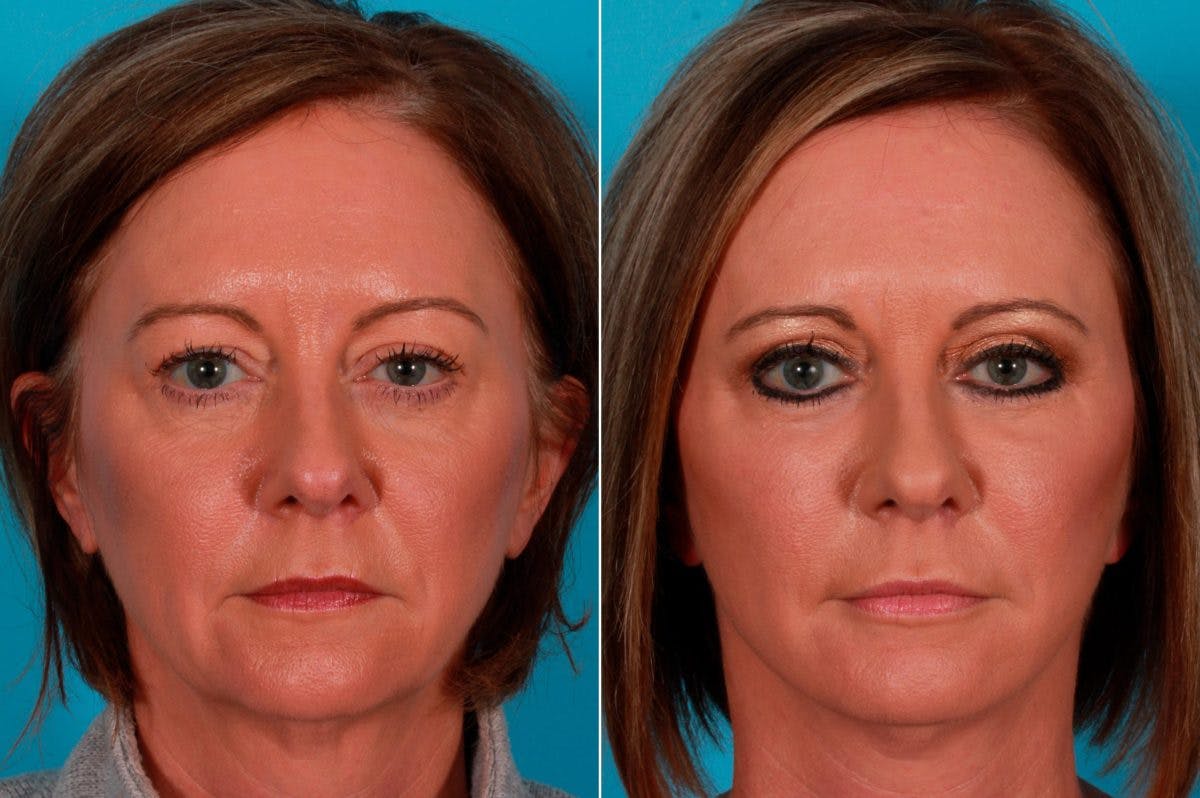 Limited Incision Facelift Before & After Gallery - Patient 376424 - Image 1