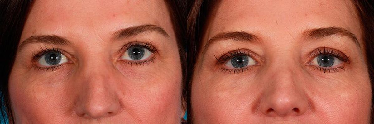 Belotero Before & After Gallery - Patient 144380 - Image 2