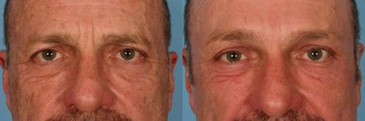 Eyelid Surgery (Blepharoplasty) Before & After Gallery - Patient 109092 - Image 4