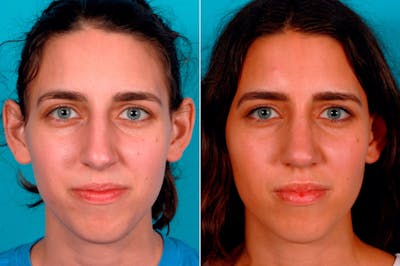 Nasal Obstruction Before & After Gallery - Patient 100593 - Image 1