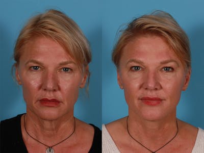Limited Incision Facelift Before & After Gallery - Patient 222585 - Image 1