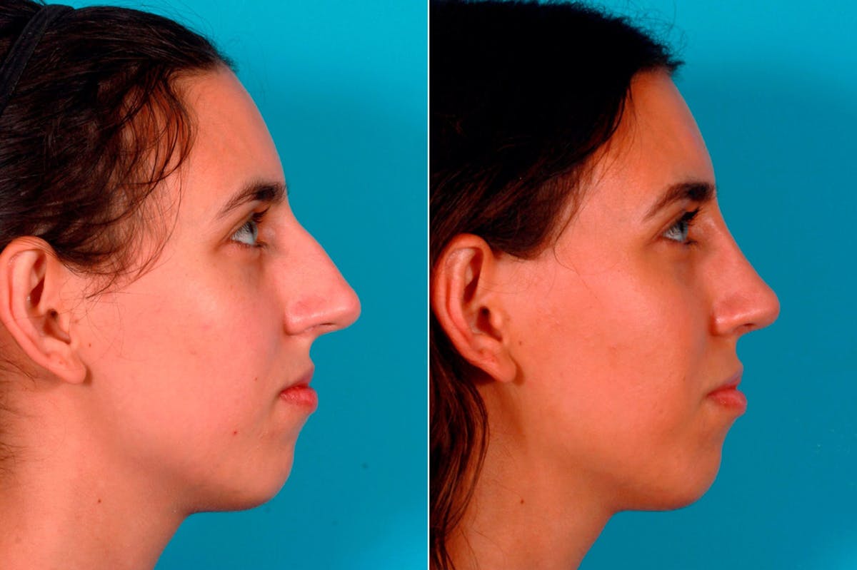 Nasal Obstruction Before & After Gallery - Patient 100593 - Image 3