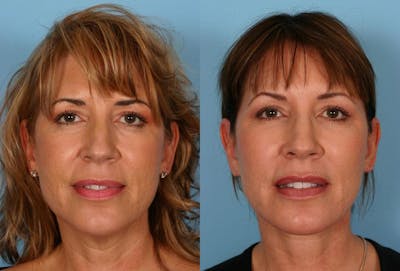 Facial Fat Transfer Before & After Gallery - Patient 354303 - Image 1