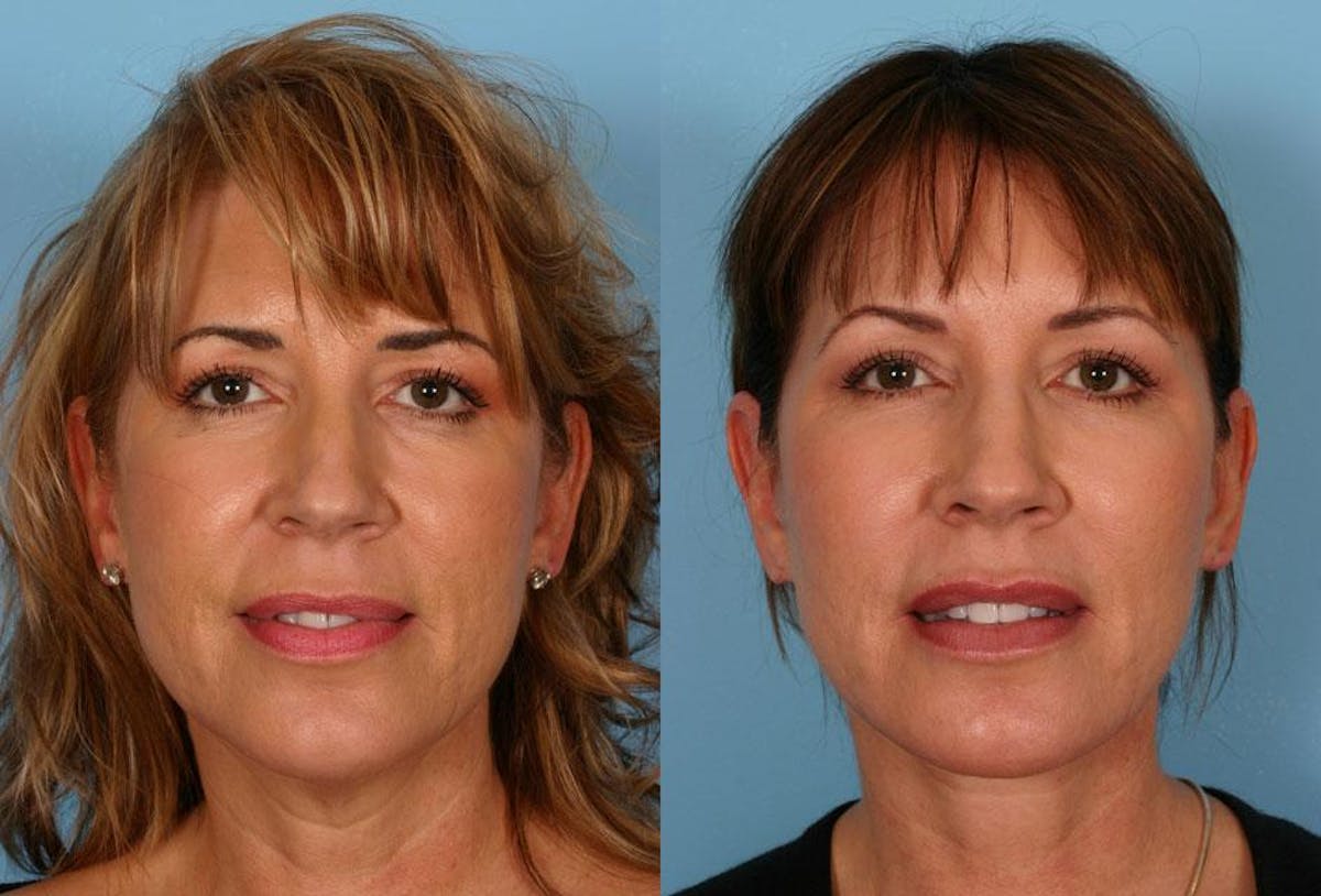 Facial Fat Transfer Before & After Gallery - Patient 354303 - Image 1