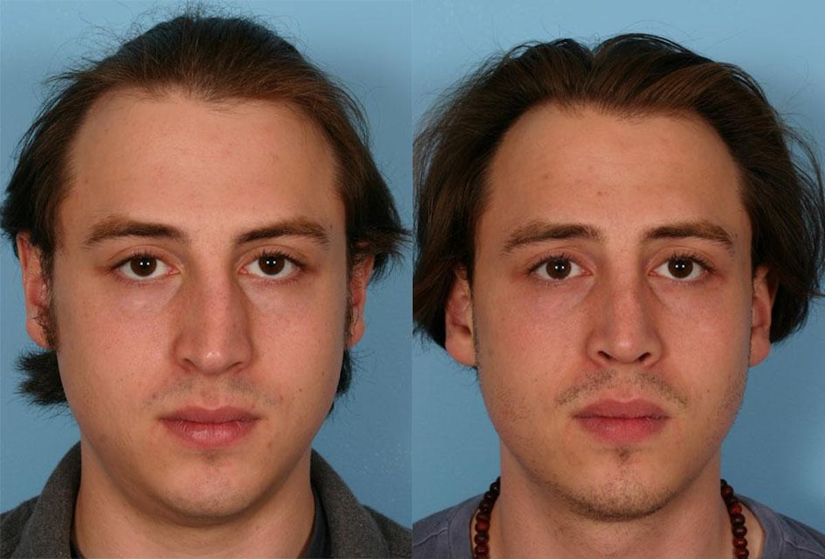 Rhinoplasty Before & After Gallery - Patient 402940 - Image 1