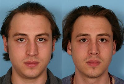 Rhinoplasty Before & After Gallery - Patient 402940 - Image 1