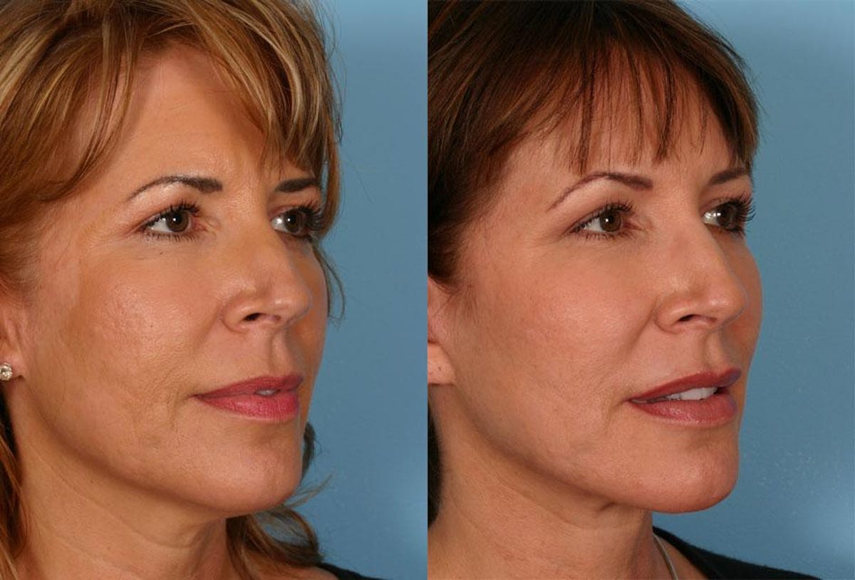 Facial Fat Transfer Before & After Gallery - Patient 354303 - Image 2