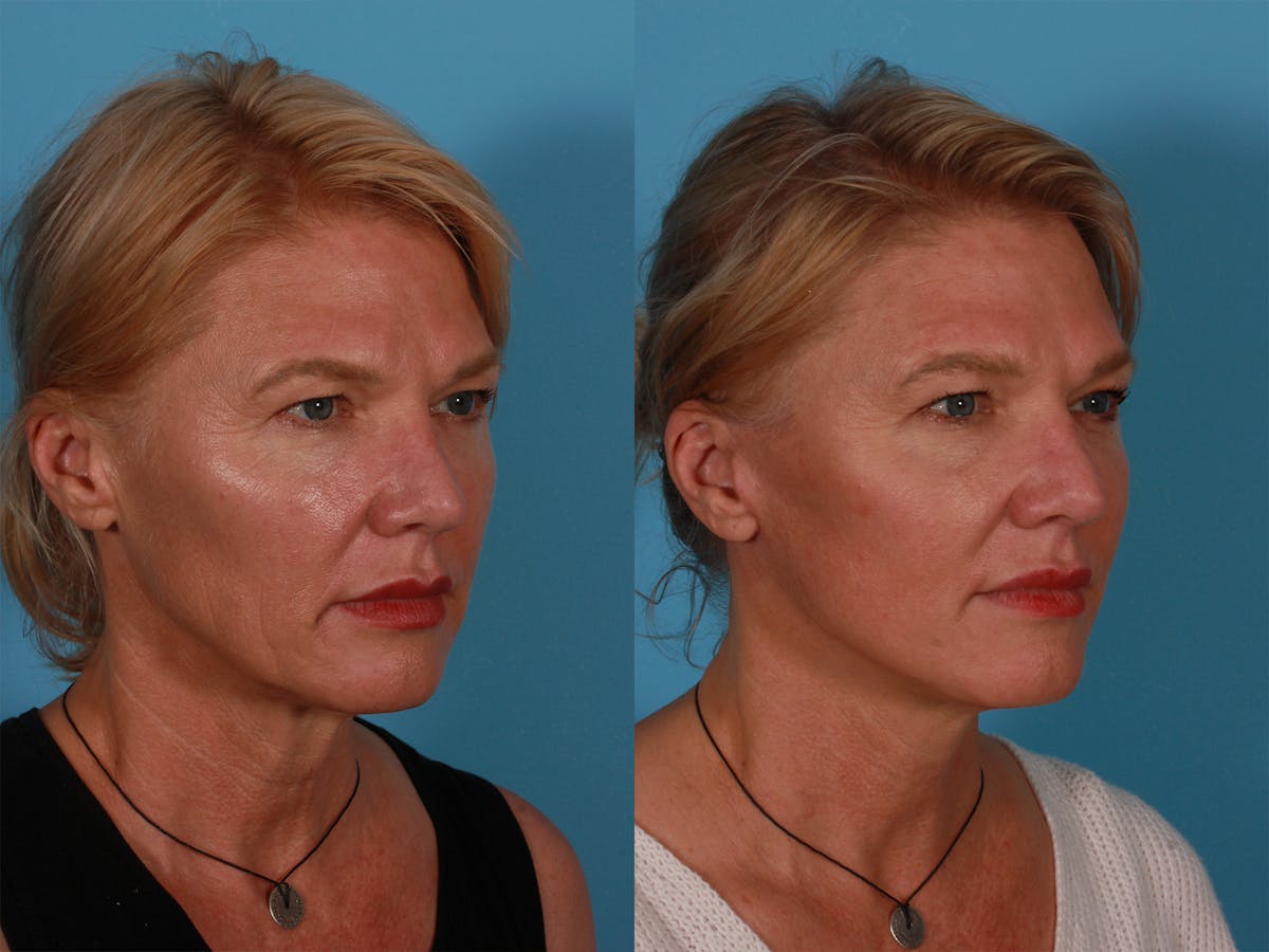 Limited Incision Facelift Before & After Gallery - Patient 222585 - Image 2