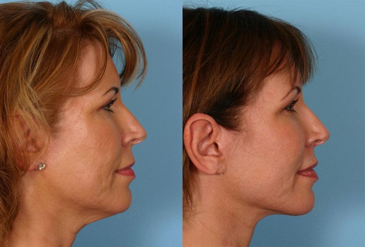Facial Fat Transfer Before & After Gallery - Patient 354303 - Image 3