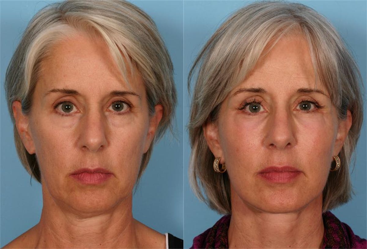 Facial Fat Transfer Before & After Gallery - Patient 154553 - Image 1