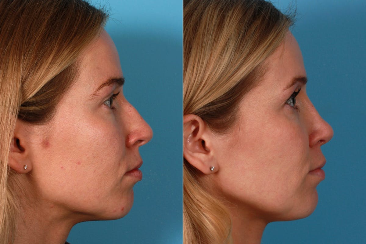 Nasal Obstruction Before & After Gallery - Patient 150975 - Image 3