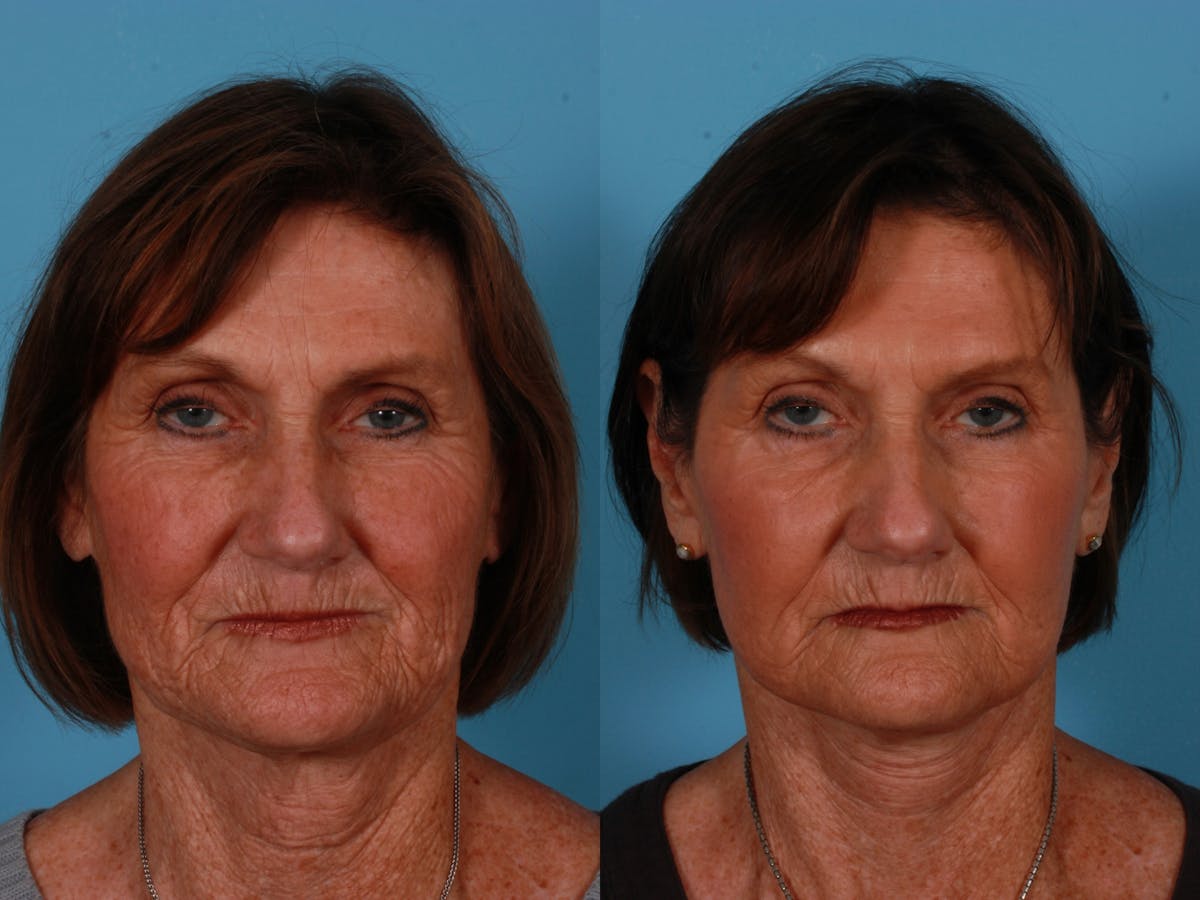 Limited Incision Facelift Before & After Gallery - Patient 583706 - Image 1
