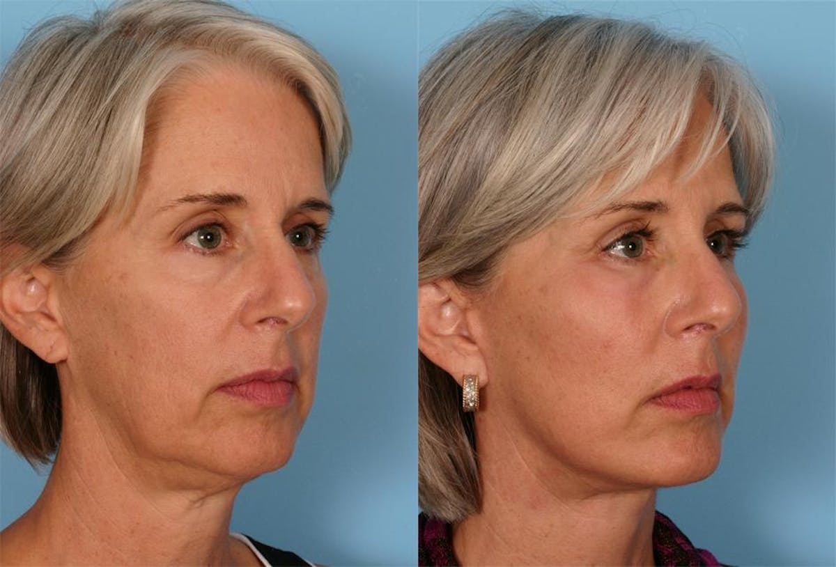 Facial Fat Transfer Before & After Gallery - Patient 154553 - Image 2